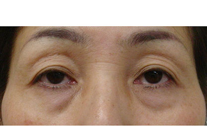 瞼のたるみ取り手術 公式 飯尾形成外科クリニック 美容外科 美容整形